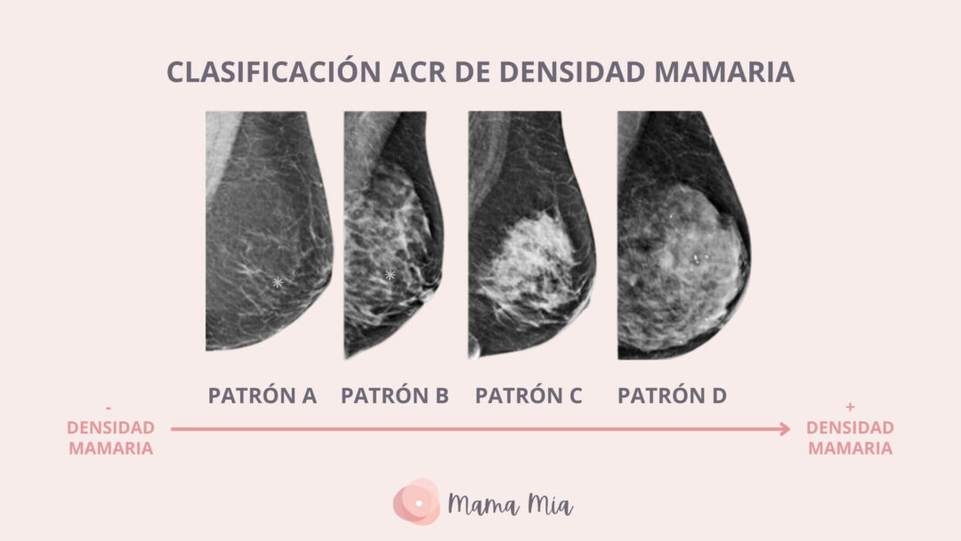 ¿Qué significa tener las mamas densas o fibroquísticas? - Dra. Pilar ...